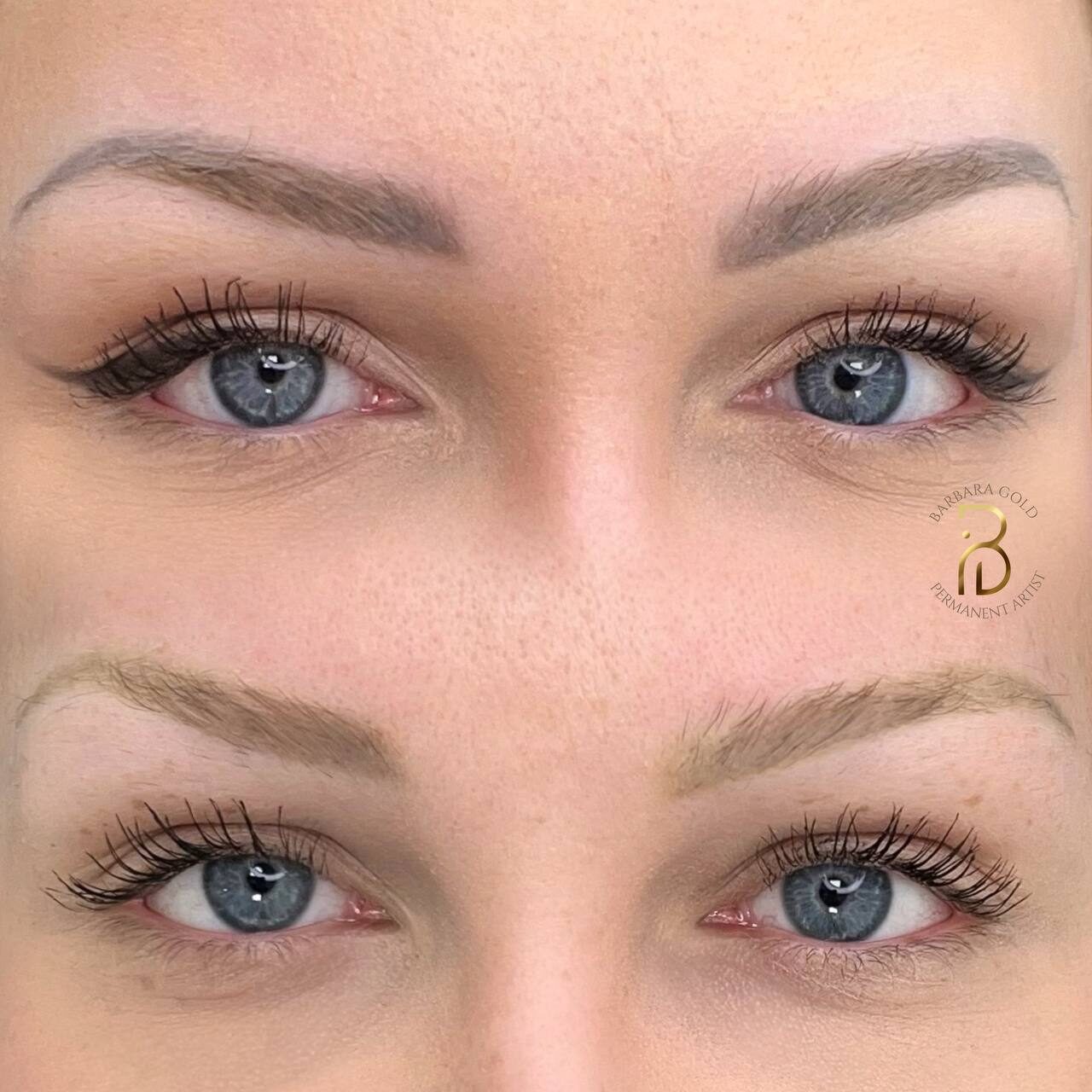 Cejas con micropigmentación antigua gris y resultado tras la eliminación