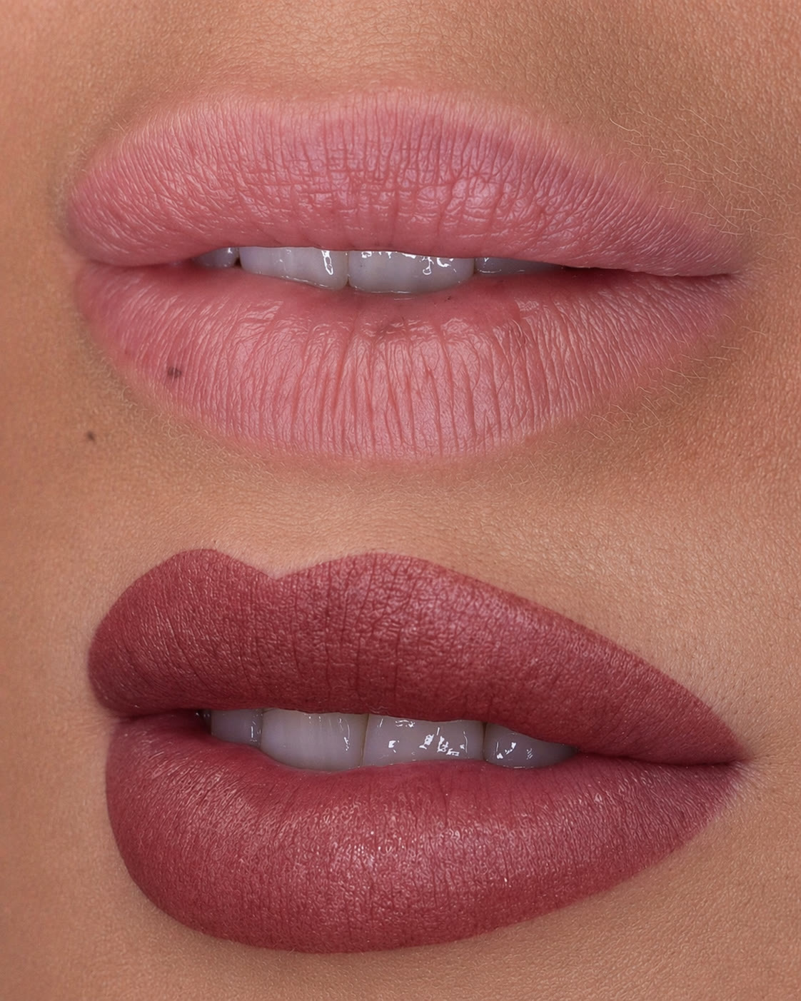 Comparativa de labios antes y después